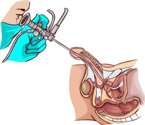 Cistoscopia ilustração