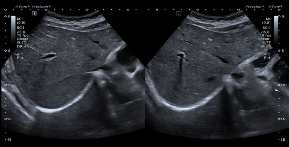 ecografia abdominal superior