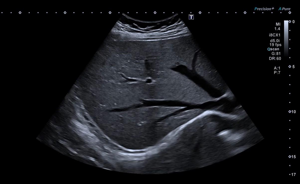 Renal and Adrenal Ultrasound