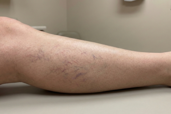 Tratamento de derrames a laser nas pernas