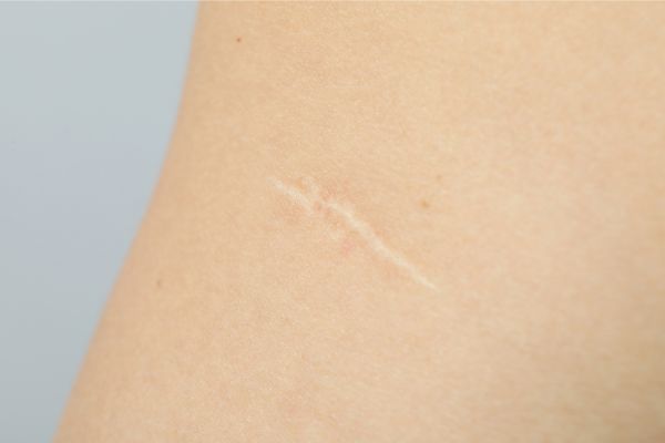 Tratamento de cicatrizes a laser