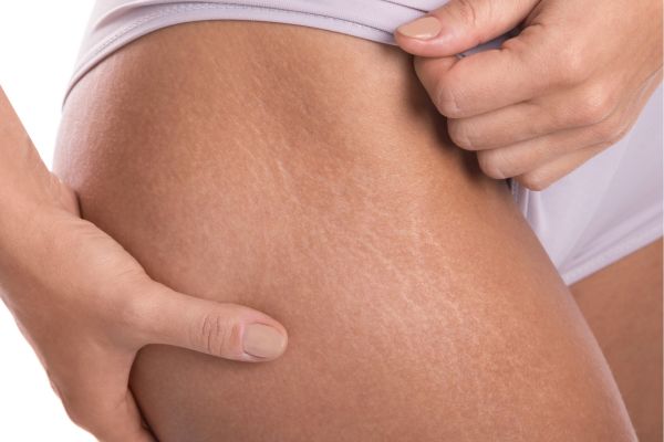 Tratamento de estrias a laser
