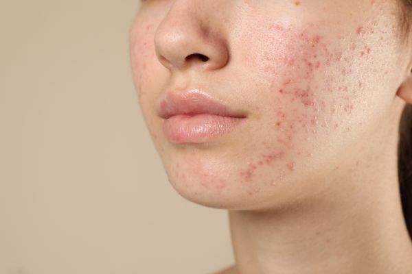 Rosto com marcas, textura irregular e manchas de acne antes de tratamento de cicatrizes a laser