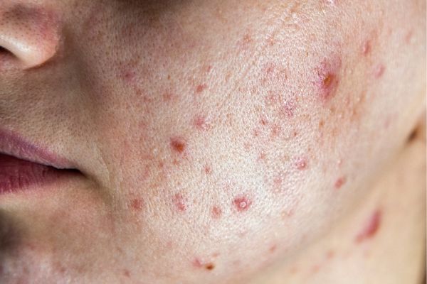 Pele do rosto com acne inflamatória, borbulhas e vermelhidão localizada