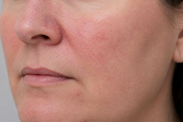 Rosto com derrames faciais, pequenos vasos visíveis e vermelhidão localizada